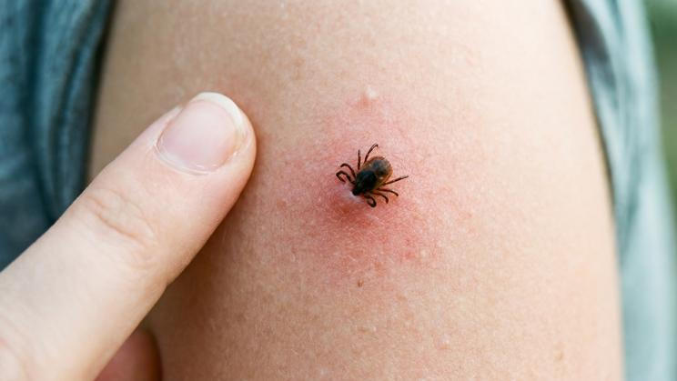 A,Close,Up,Shot,Of,A,Tick,Attached,To,Human