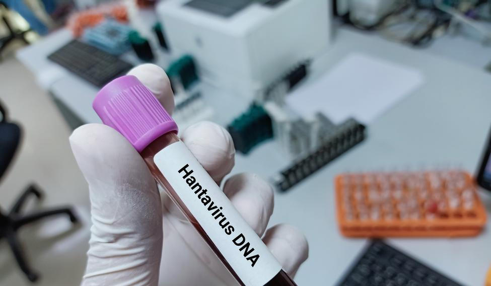 Lab,Technologist,Hold,Blood,Sample,For,Hantavirus,Dna,Test.,Laboratory