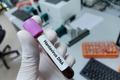 Lab,Technologist,Hold,Blood,Sample,For,Hantavirus,Dna,Test.,Laboratory