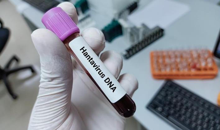 Lab,Technologist,Hold,Blood,Sample,For,Hantavirus,Dna,Test.,Laboratory