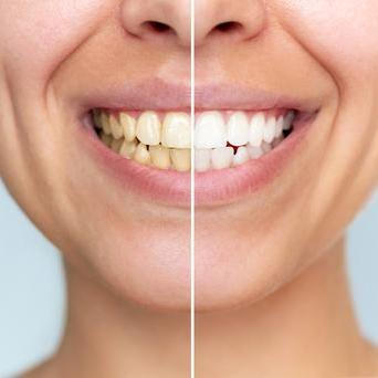 Některé skvrny zůstávají na povrchu a dají se odstranit dentální hygienou, jiné však při dlouhodobém působení pronikají hlouběji do struktury zubu, zejména pokud je sklovina oslabená.