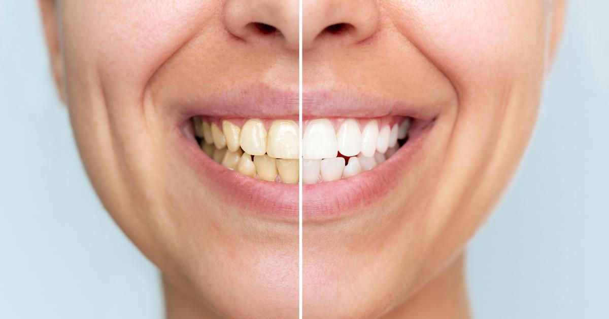 Některé skvrny zůstávají na povrchu a dají se odstranit dentální hygienou, jiné však při dlouhodobém působení pronikají hlouběji do struktury zubu, zejména pokud je sklovina oslabená.