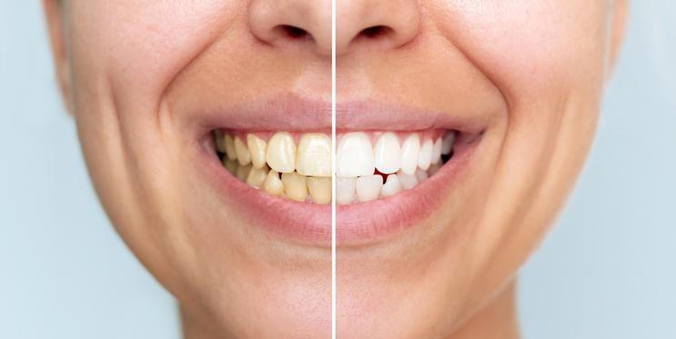 Některé skvrny zůstávají na povrchu a dají se odstranit dentální hygienou, jiné však při dlouhodobém působení pronikají hlouběji do struktury zubu, zejména pokud je sklovina oslabená.