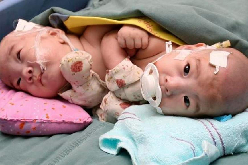 Na Slovensku se narodila siamská dvojčata, informují média
