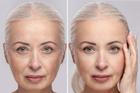Facelift