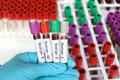 Blood,Type,Rh,Negative,Test,,Blood,Sample,To,Analyze,In