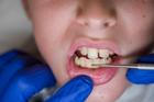 Open,Mouth,Of,A,Boy,Cleaning,Tartar,In,Dentist