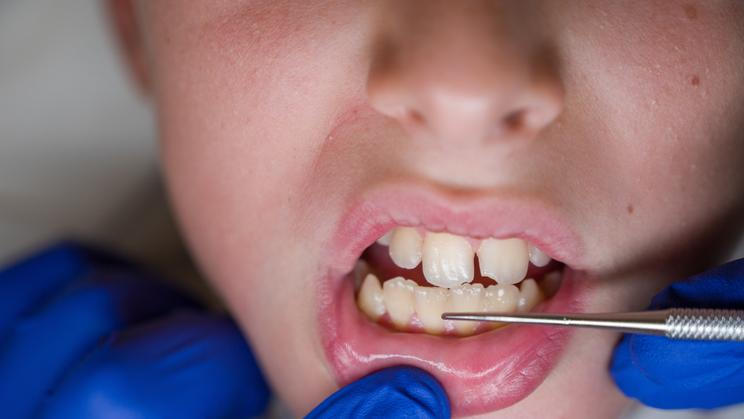 Open,Mouth,Of,A,Boy,Cleaning,Tartar,In,Dentist