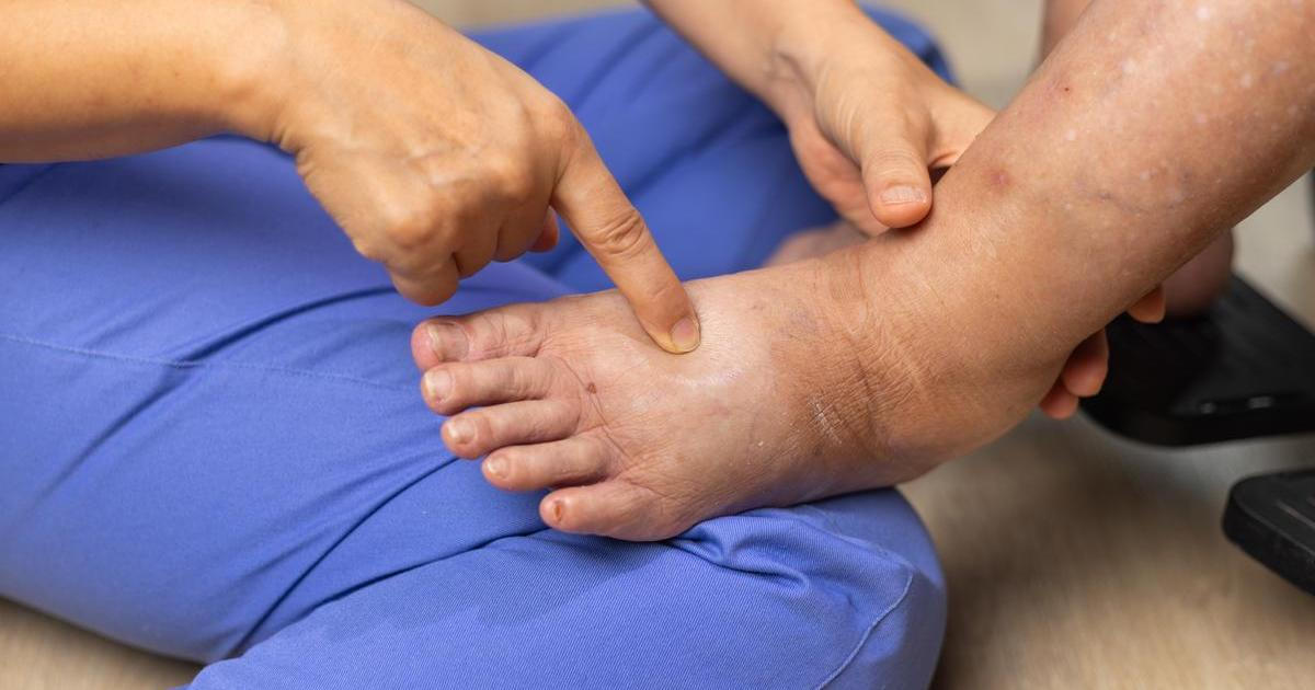 Nohy vám mohou prozradit víc, než čekáte. Tmavé skvrny bývají varováním před špatným prokrvením