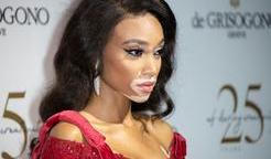Winnie Harlow