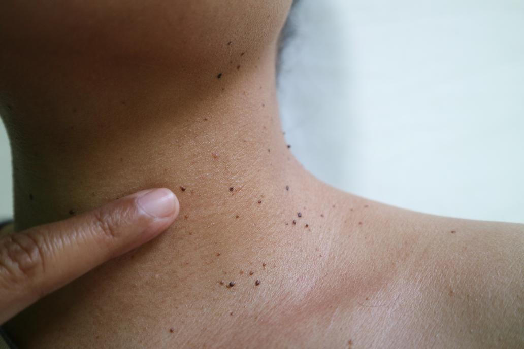 Nejčastěji se s fibromy setkáte v místech, kde dochází ke tření pokožky, tedy na krku, v podpaží nebo pod prsy. Fibromy