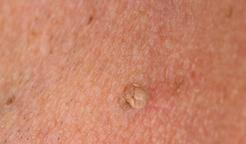 Fibrom