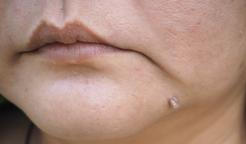 Fibrom