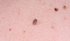Fibrom