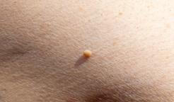 Fibrom