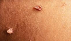 Fibrom