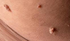 Fibrom