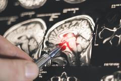 Parkinsonova nemoc