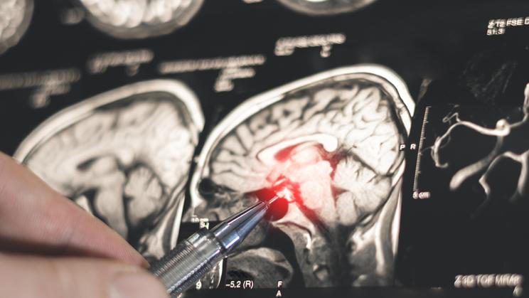 Parkinsonova nemoc