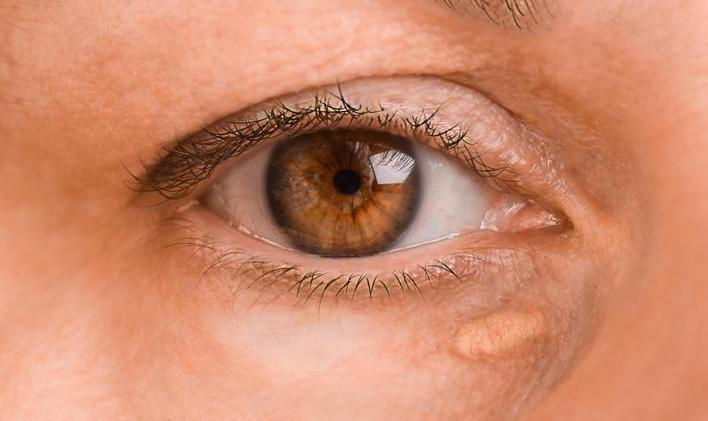 The,Left,Female,Eye,Of,A,Woman,With,Drooping,Eyelid,