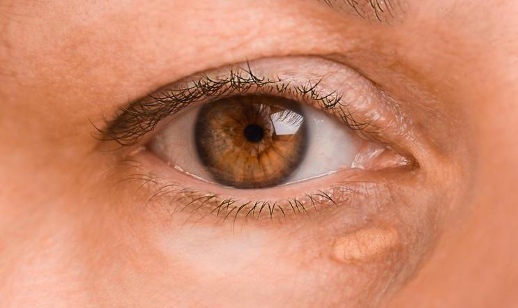 The,Left,Female,Eye,Of,A,Woman,With,Drooping,Eyelid,