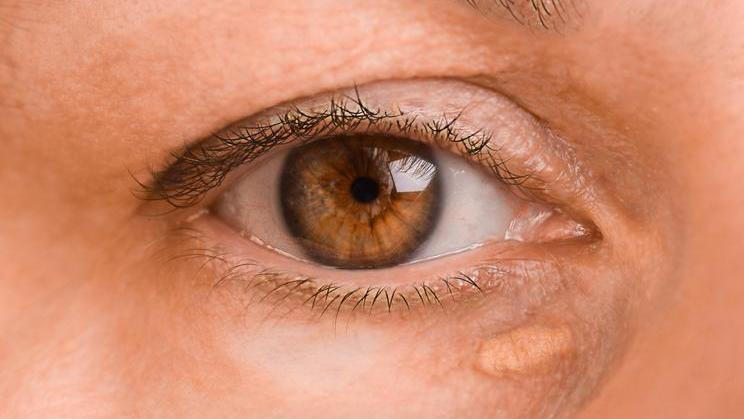 The,Left,Female,Eye,Of,A,Woman,With,Drooping,Eyelid,