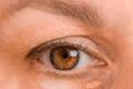 The,Left,Female,Eye,Of,A,Woman,With,Drooping,Eyelid,