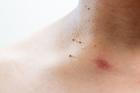 Fibromy