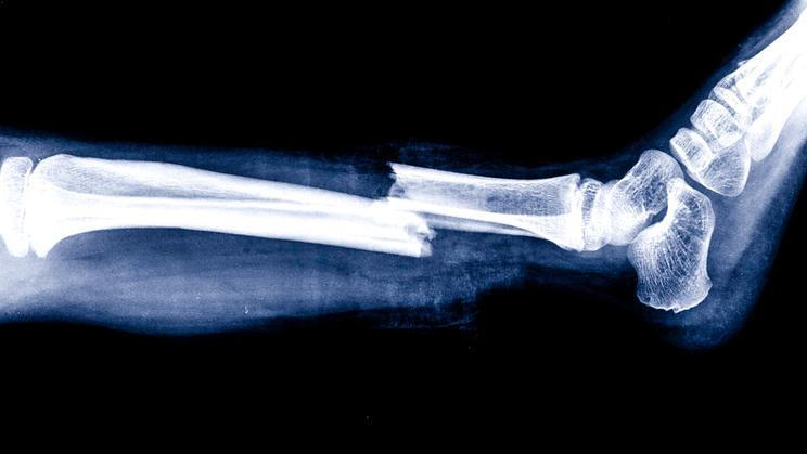 X-ray,Image,Showing,Broken,Leg,Bone,With,Visible,Fracture,Near